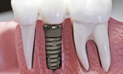 Thời răng trồng răng sứ sẽ được bác sĩ quyết định dựa theo từng trường hợp cụ thể