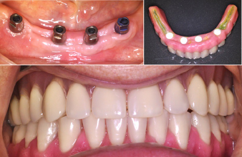 Trồng răng sứ nguyên hàm giá bao nhiêu còn phụ thuộc vào nhiều yếu tố