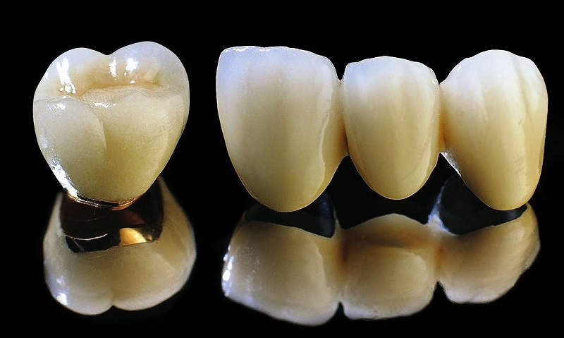 Các mẫu răng sứ titan phổ biến hiện nay