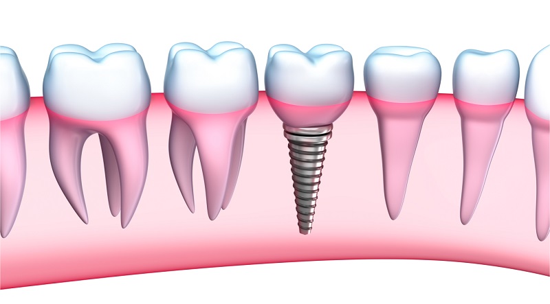 Trồng răng sứ vĩnh viễn mang đến hàm răng thẩm mỹ, bền chặt lâu dài