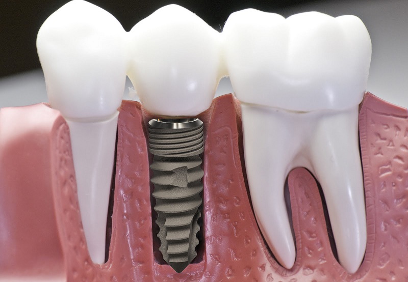 Răng được làm bằng trụ Implant