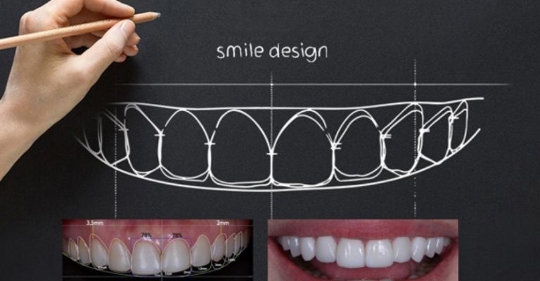 Công nghệ tái tạo nụ cười 3D - Smile Design của ViDental: Số 1 tại Việt Nam