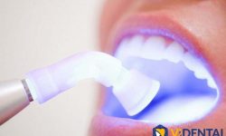 Công nghệ trám răng hiện đại bậc nhất tại Vidental