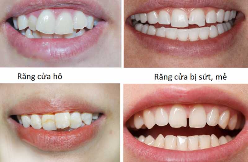 Một số dịch vụ nha khoa tại phòng khám răng Hùng Cường