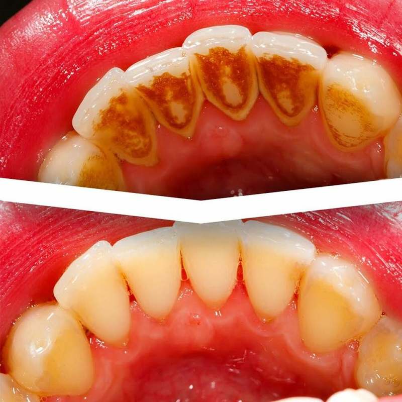 nha khoa quận Nam Từ Liêm Nha khoa Hồng Phong giúp làm trắng răng, cho nụ cười tự tin