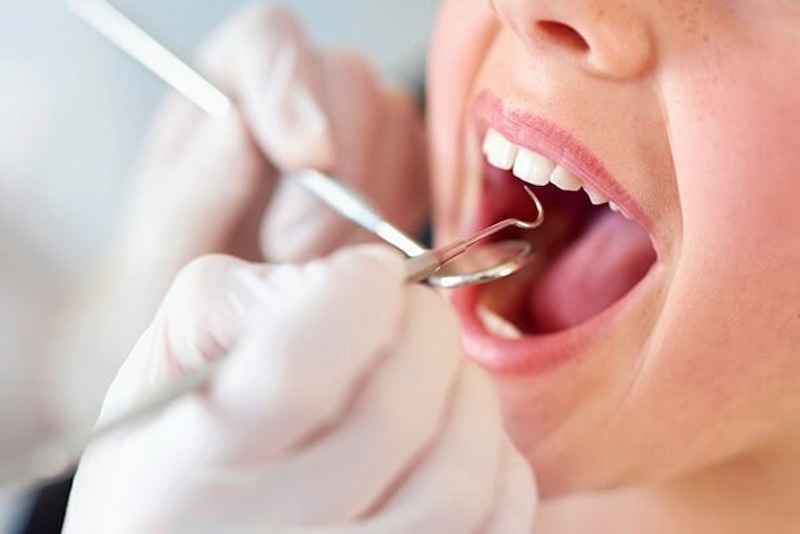 Quy trình cạo vôi răng tại nha khoa rất đơn giản, nhanh chóng