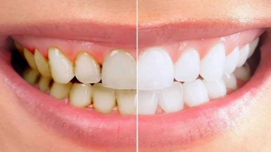 Cần tìm hiểu cao răng là gì để có biện pháp loại bỏ hợp lý