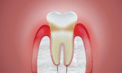 Nướu răng là gì? Là các mô mềm nằm ở vị trí chân răng