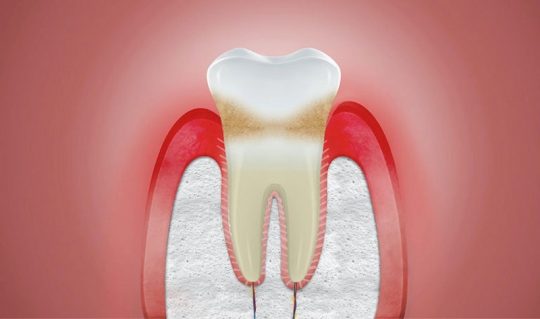 Nướu răng là gì? Là các mô mềm nằm ở vị trí chân răng