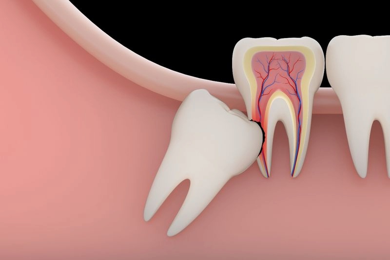 Răng khôn mọc ngầm ảnh hưởng rất lớn đến răng số 7