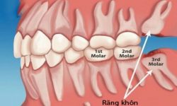 Răng khôn là răng mọc khi cung hàm đã hoàn chỉnh