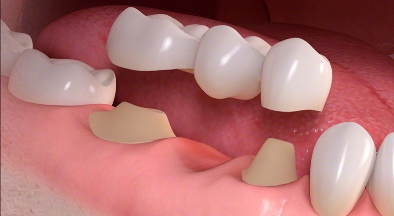 Trồng răng sứ là một trong những dịch vụ nổi bật tại Nha khoa Khiết Tâm 