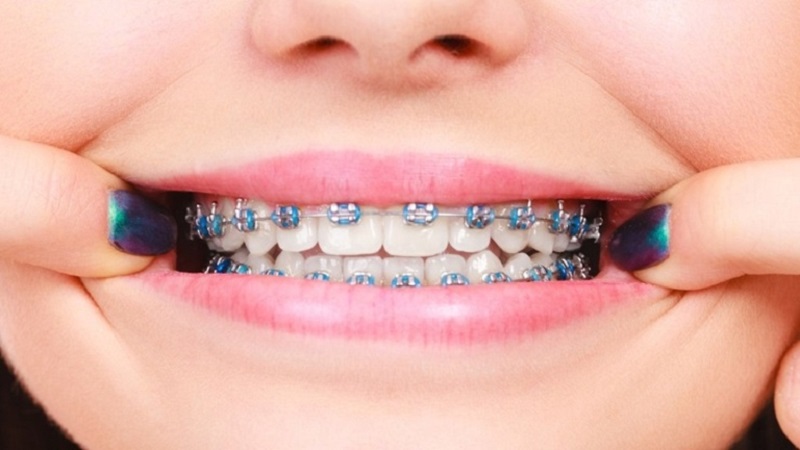 Các bạn có thể tham khảo niềng răng chất lượng tại Nha khoa Bạch Mai