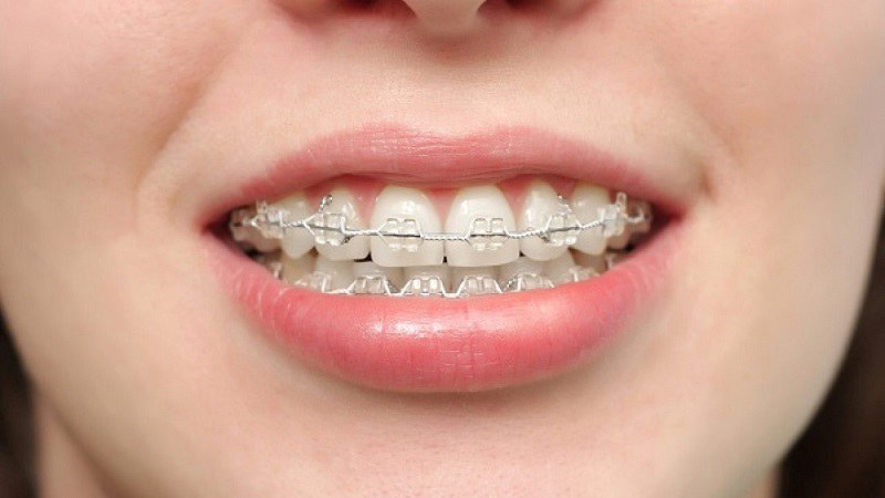 Niềng răng là dịch vụ nha khoa phổ biến tại Nha khoa Nụ Cười Việt