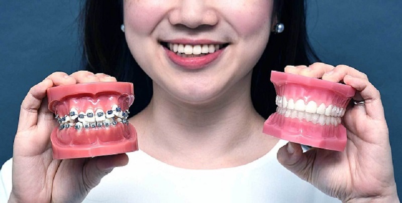 Nha khoa Phú Mỹ nổi tiếng với dịch vụ niềng răng