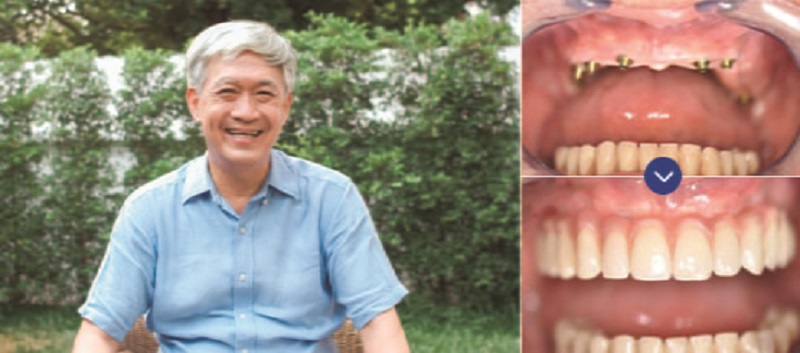 Ông Trần Văn Đan – Khách hàng trồng răng Implant nguyên hàm tại Nha khoa ViDental