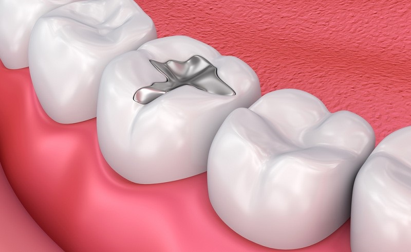 Nha khoa ở Sơn La - Smile nổi bật với dịch vụ trám răng