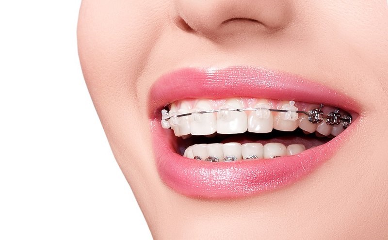 Niềng răng là loại hình nha khoa nổi bật tại Hàn Lâm