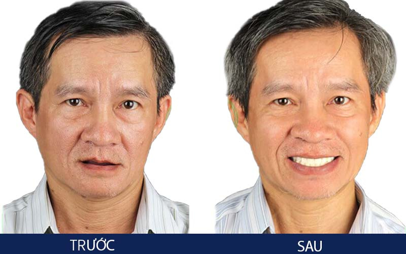 Hình ảnh khách hàng sau khi trồng răng Implant tại Nha khoa ViDental