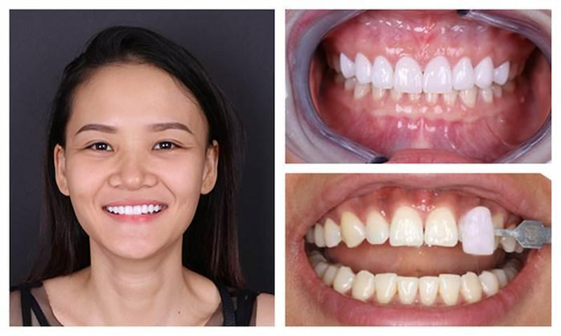Hình ảnh Quỳnh Anh sau khi thực hiện bọc răng sứ tại ViDental
