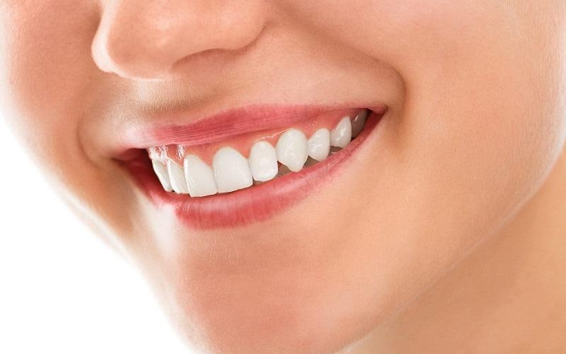 Bọc răng sứ mang đến hàm răng trắng đều và đẹp như mong muốn