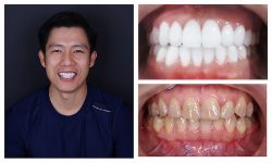 Bọc răng sứ tại ViDental là sự trải nghiệm của chất lượng, công nghệ và sự tận tâm