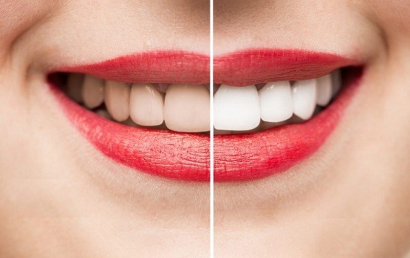 Hàm răng trắng sáng sẽ giúp tự tin hơn trong giao tiếp
