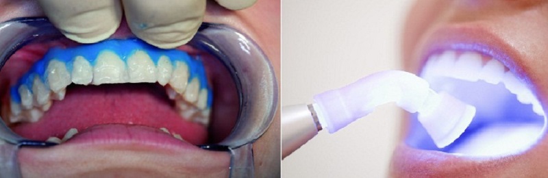 Công nghệ làm trắng răng bằng Plasma được sử dụng rộng rãi tại các phòng khám nha khoa