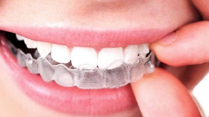 Sử dụng máng để làm trắng răng đang rất được ưa chuộng bởi sự thuận tiện