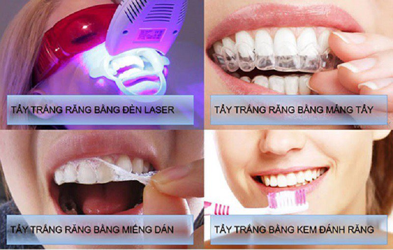 Hiện nay các phương pháp tẩy trắng răng khá đa dạng