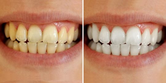 Tẩy trắng răng sai cách sẽ mang lại nhiều tác hại nguy hiểm