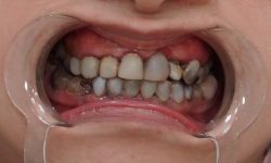 Hậu quả bọc răng sứ giá rẻ