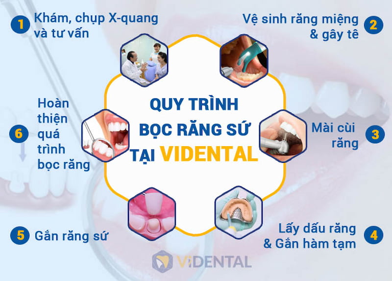 Quy trình bọc răng sứ tại Viện Nha khoa ViDental.