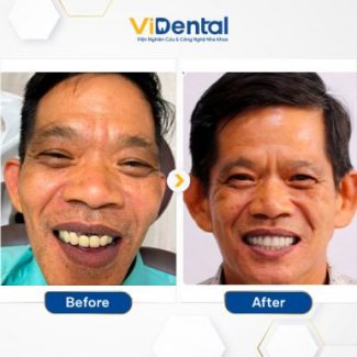 Chú Hà Văn Tiến (bố Vân) - Khách hàng trồng răng tại nha khoa ViDental