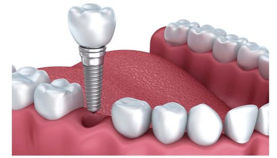Trồng răng implant mang lại hiệu quả ăn nhai tối ưu