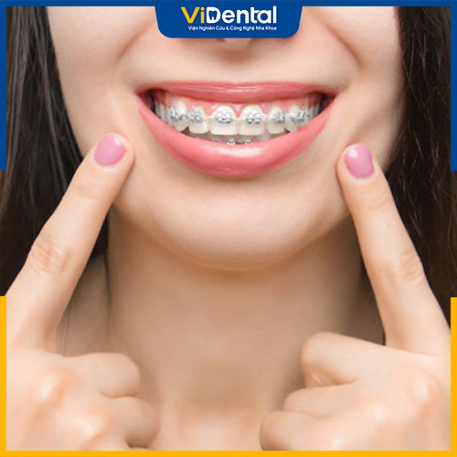 Một số lưu ý khi lựa chọn địa chỉ niềng răng tại TP.HCM