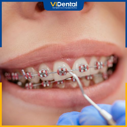 Dịch vụ niềng răng - chỉnh nha tại Dr Vương được đánh giá cao