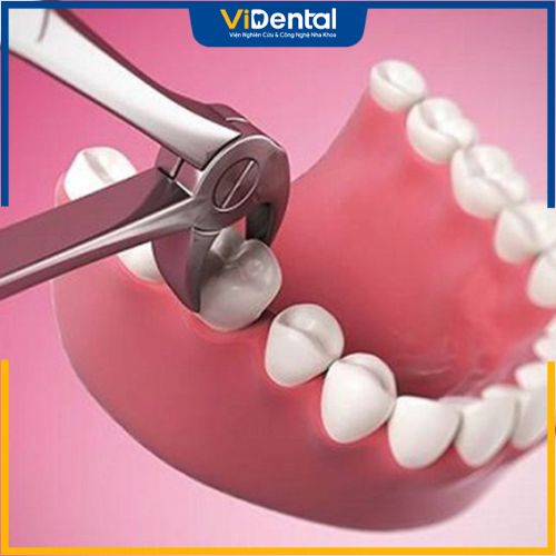 Nhổ răng là một trong những dịch vụ của Nha khoa Uni Dental