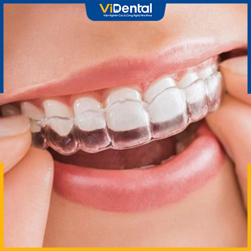 3 lưu ý trong quá trình thực hiện niềng răng Invisalign ở TPHCM 