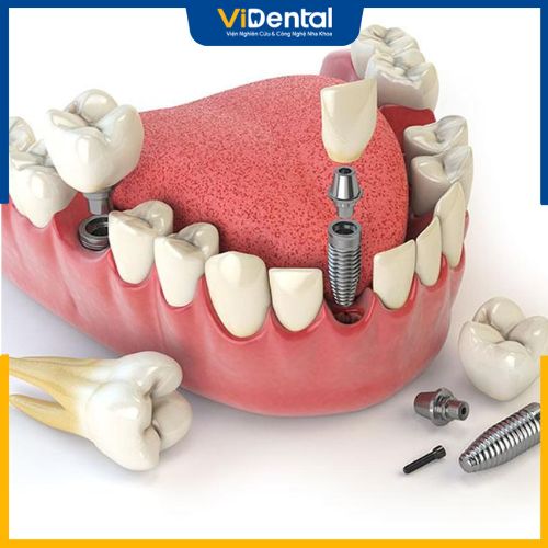 ViDental có Trung tâm Chế tác răng sứ riêng biệt