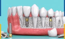 [Xem Ngay] Top 8 Địa Chỉ Trồng Răng Implant Trả Góp TPHCM 