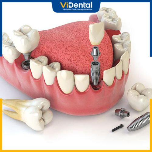 ViDental là địa chỉ uy tín trong cấy ghép Implant