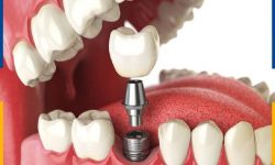 Top 9 Địa Chỉ Trồng Răng Implant Uy Tín TPHCM Bạn Nên Tới
