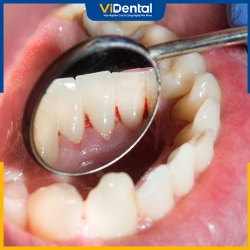 Tình trạng chảy máu chân răng có thể gặp phải ở nhiều độ tuổi