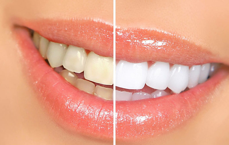 Tẩy trắng răng là phương pháp nha khoa thẩm mỹ giúp răng trắng sáng