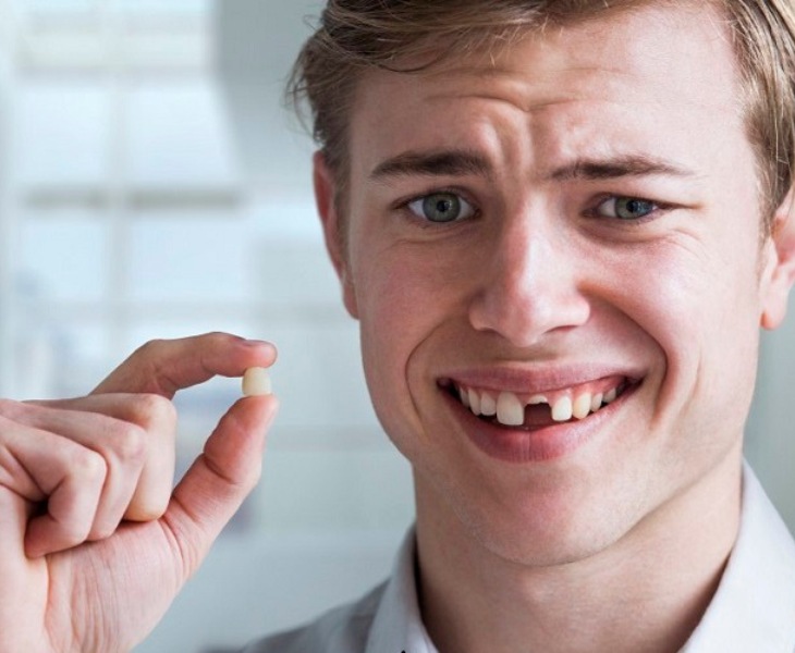 Răng bị gãy chỉ còn chân răng thì không thể bọc sứ 
