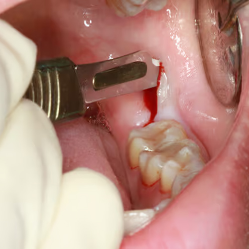 Nhổ răng khôn tại cơ sở không uy tín có thể gặp biến chứng