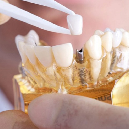 Nha khoa Việt Đức Củ Chi nổi bật với dịch vụ trồng răng giả