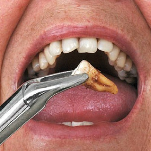 Nhổ răng có gây đau nhức sau khi thuốc tê hết tác dụng