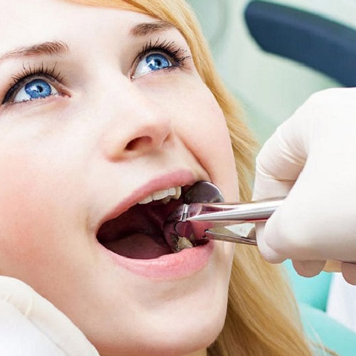 Nên lựa chọn nha khoa uy tín để nhổ răng an toàn